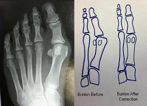 Norridge bunion surgeon 