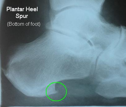 Retro hot sale heel spur